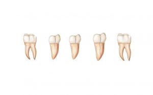 Синдром треснувшего зуба