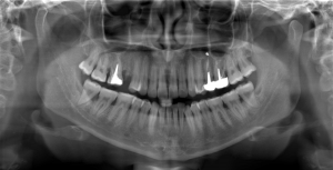 Панорамный снимок зубов — ортопантомограмма