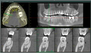 Конусно-лучевая компьютерная томография