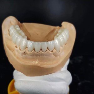 Полная реконструкция зубного ряда, усправление кривизны прикуса