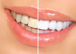 Кому нельзя отбеливать зубы?
